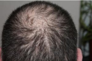 cara alami mengatasi rambut rontok