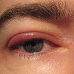 Blepharitis - infeksi kelopak mata
