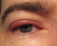 Blepharitis - infeksi kelopak mata